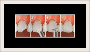 Seasons of Smiles - Cosmetic Bonding This photo shows the process of dental bonding.
