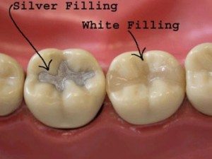 Seasons of Smiles - Fillings This picture shows two teeth with fillings.