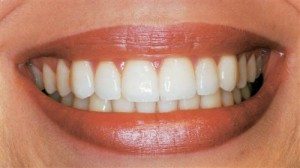 Seasons of Smiles - Gum Lift A gum lift could make your new smile look even more spectacular.