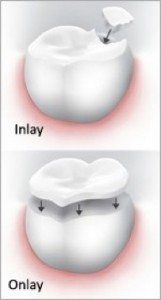 Seasons of Smiles Dental - Inlay Onlay Photo of a Porcelain onlay and inlay.
