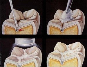 Sealants Photo illustration of dental sealants.
