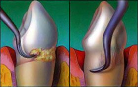 Professional Dental Cleaning Before/after photo of a tooth having a professional dental cleaning.