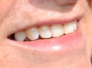 Nellie Clark's Smile Up Close