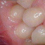 This is an "after" photo showing how beautiful a restored tooth looks like with e.max.