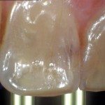 Before photo - Tooth #9 with decay.