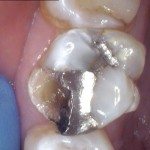 The mesial buccal cusp is broken off tooth #14.