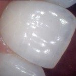 Central incisor showing translucency.