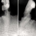 X-Rays showing teeth #'s 22,27.
