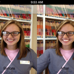 Before After Tooth Whitening
