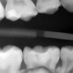 X-ray showing from a young patient with holes in his teeth.