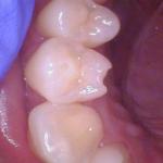 What happens when you bite down on your tongue ring