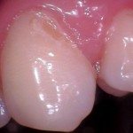 The tooth is broken down completely. There is a hole where the enamel has worn away.