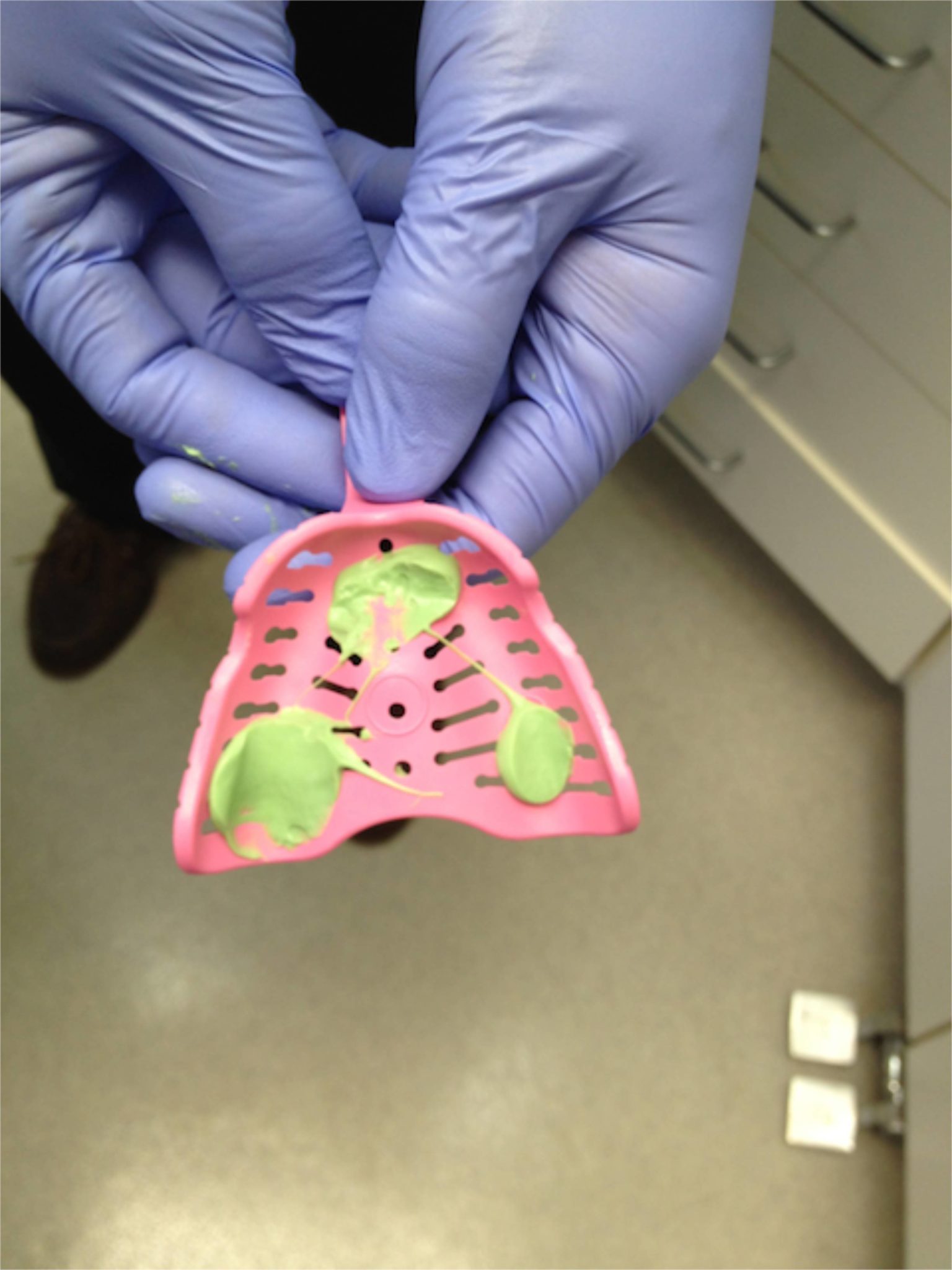 Dentures FAQ The Second Visit Seasons of Smiles Dental