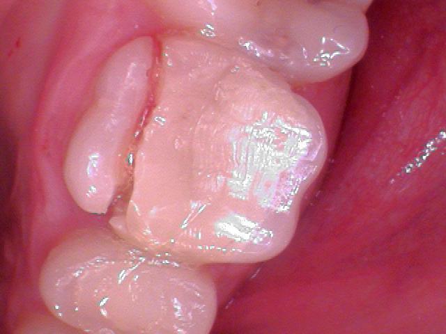 Why are crowns recommended after root canals?