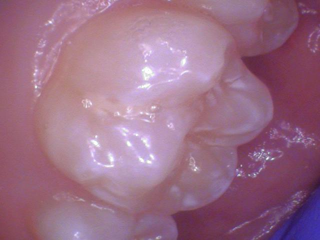 When To Use Teeth Whitening Strips