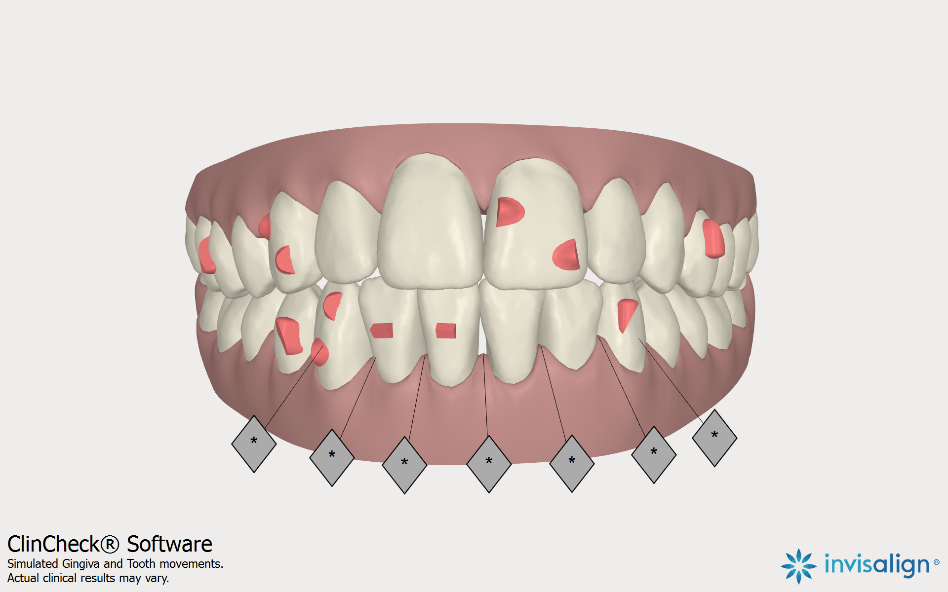Invisalign Orthodontic Records and ClinCheck