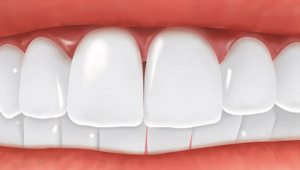 Missing tooth replaced by a dental implant