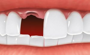 Missing tooth